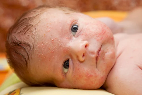 Новорожденный ребенок. на лице сыпь, Угри новорожденных — стоковое фото