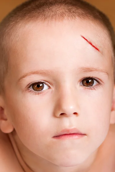 Рана ребенка — стоковое фото