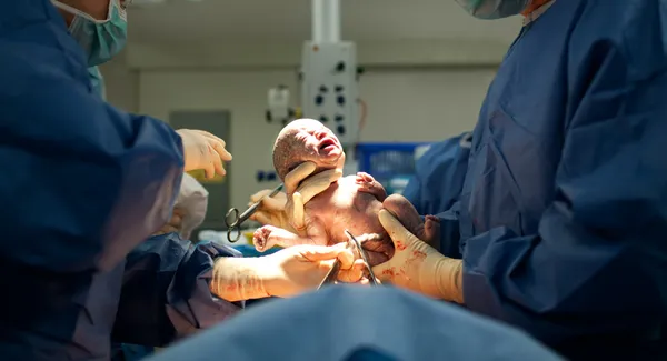 Ребенок, рождающийся через кесарево сечение — стоковое фото